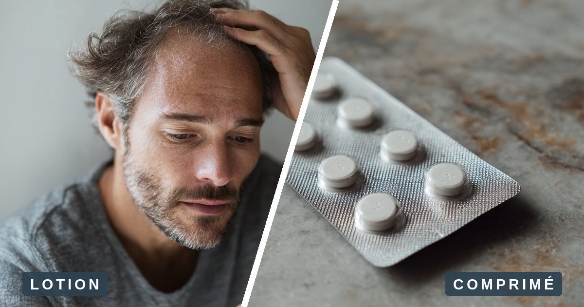 Minoxidil en lotion et minoxidil en comprimé, côte à côte