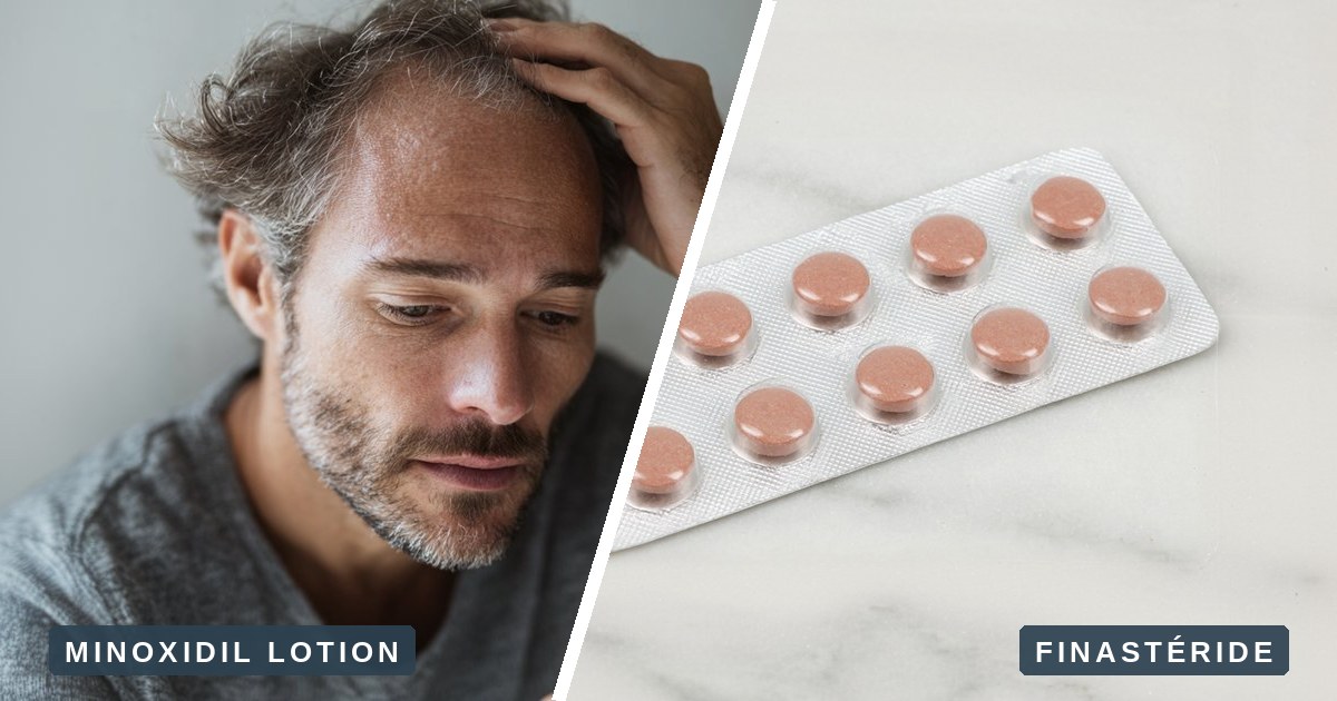 Lotion de minoxidil et comprimés de finastéride, côte à côte